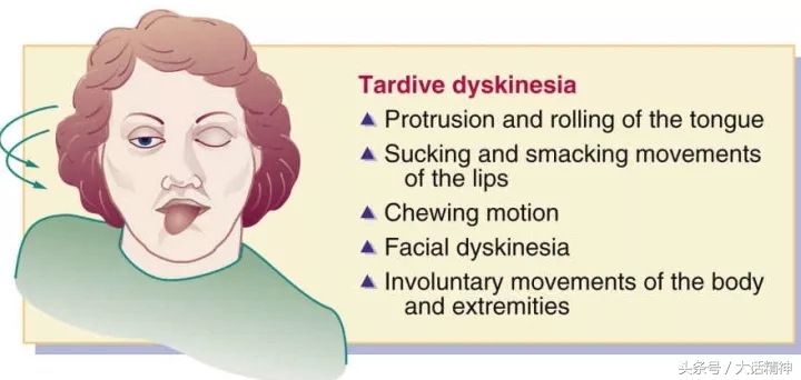 治疗迟发性运动障碍的新药,迟发性运动障碍用哪种药