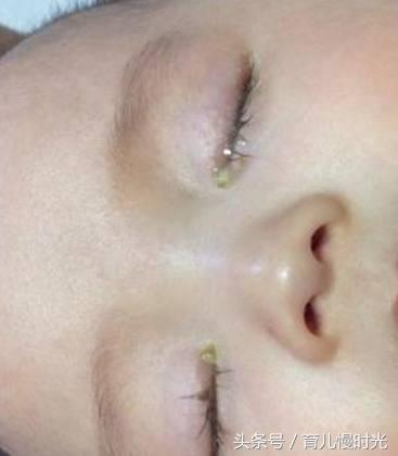 三岁宝宝眼屎多怎么按摩,左眼眼屎多按摩什么穴位去眼屎