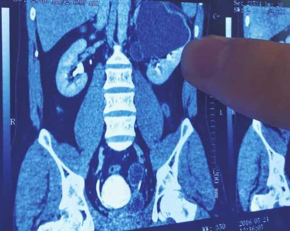 4个肾的人会发生什么,天生只有一个肾的概率是多少