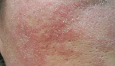 脂溢性皮炎用什么洗面奶,脂溢性皮炎用什么洗发水