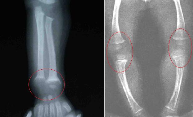 怎么查小月龄宝宝缺不缺维生素d,宝宝冬季怎么补充维生素