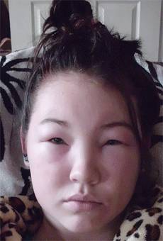 脸肿有什么感觉,脸肿了怎么自救