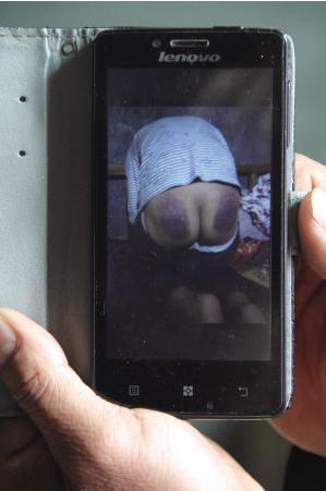 屁股淤青发紫,孩子屁股被揍肿了多久才会好