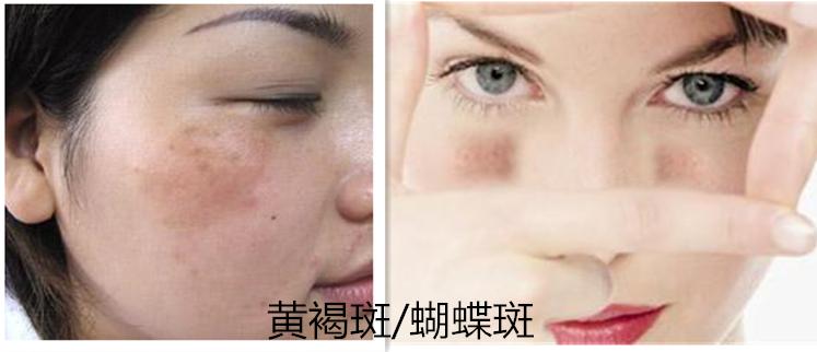 图解一分钟带你认清斑点分类，原来真的每个人都会长斑？