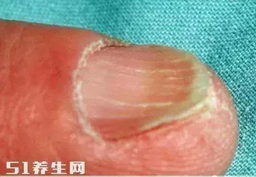 指甲有凹陷是什么原因引起的,中指甲凹陷是什么原因引起的
