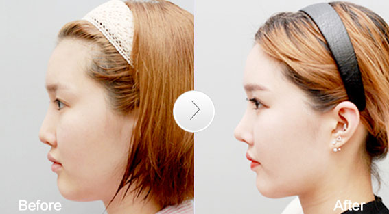 耳软骨隆鼻适合什么人做,鼻背薄适合做哪种隆鼻