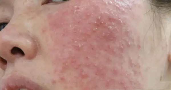 酒渣鼻怎么改善学生党,酒渣鼻严重怎么彻底治疗