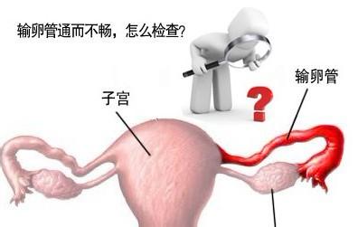 输卵管造影注意事项是什么,输卵管造影后饮食