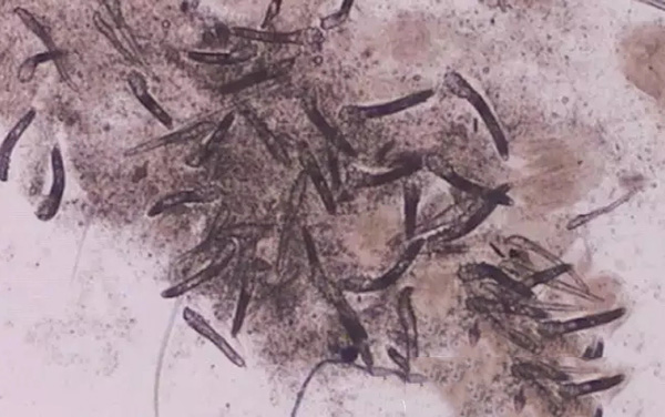 酒渣鼻怎么改善学生党,酒渣鼻严重怎么彻底治疗