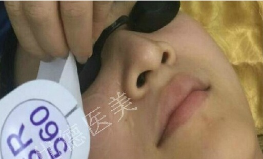 脂溢性皮炎用什么洗面奶,脂溢性皮炎用什么洗发水