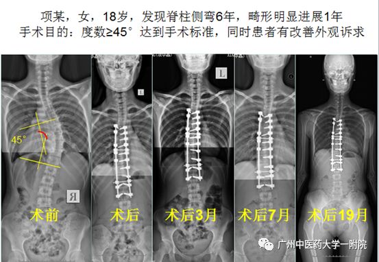 脊柱侧弯属于严重残疾吗,儿童脊柱侧弯去哪个医院好