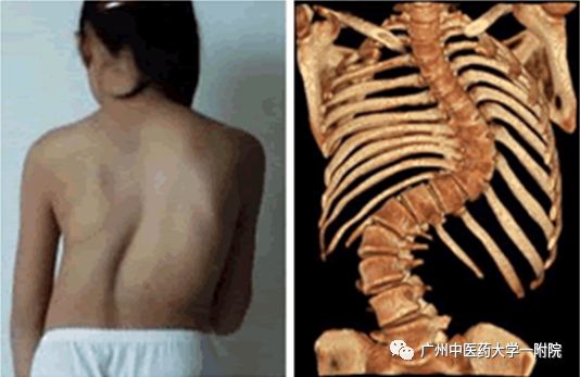 脊柱侧弯属于严重残疾吗,儿童脊柱侧弯去哪个医院好