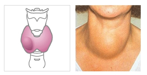 甲亢患者禁吃一览表,甲亢病人严禁吃哪些食品