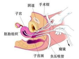 药流好还是人流好看医生怎么说,药流好还是无痛好该如何选择