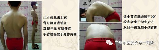 脊柱侧弯属于严重残疾吗,儿童脊柱侧弯去哪个医院好