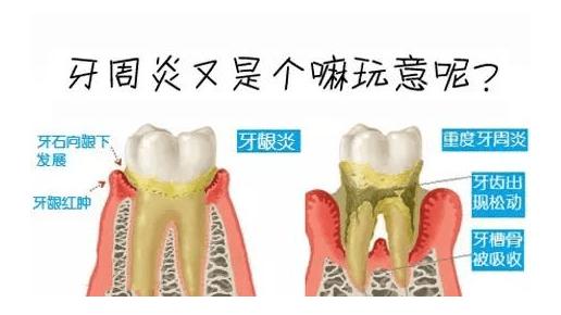 牙痛死了是什么原因,牙疼几年了不治会引起什么后果