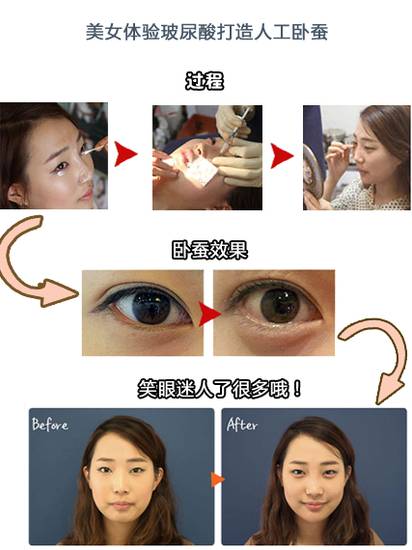 眼袋显老还是泪沟显老,40岁眼袋有泪沟怎么办