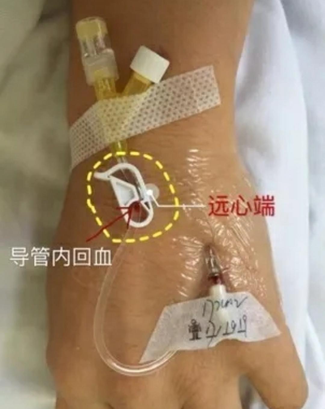 套管针的使用方法和保留方法,怎么让套管针回血