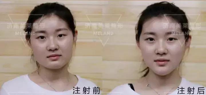 瘦脸针一次效果明显吗,瘦脸针七天效果不明显