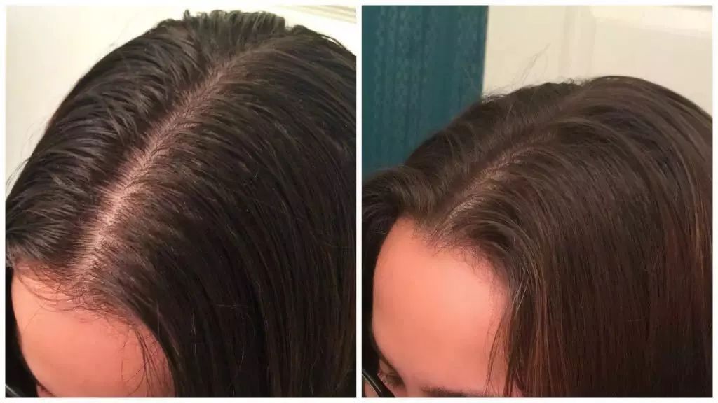 爆痘急救小妙招,今天突然爆痘怎么拯救