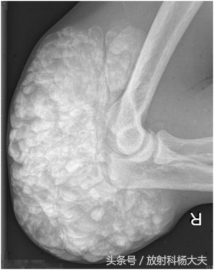 骨肉瘤是罕见病,和骨肉瘤相似的病