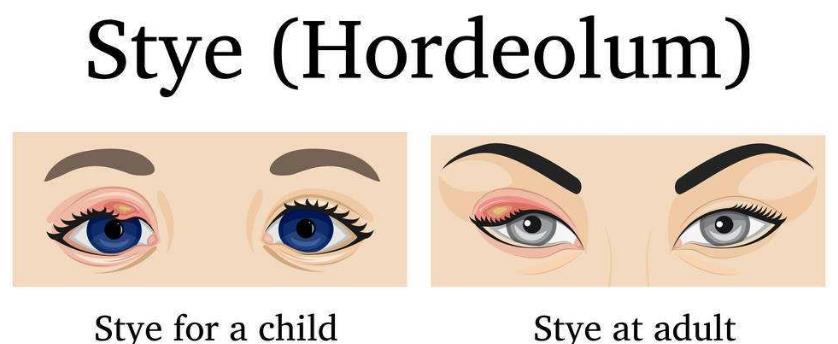 眼皮起麦粒肿什么病引起的,右眼长了麦粒肿有什么征兆