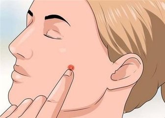 你知道什么叫痘印吗,成人痘是什么意思