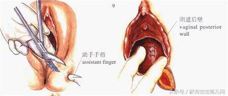 生产时，自然撕裂和侧切有什么不同？哪个恢复更快，该如何选择？