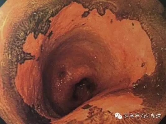 barrett食管的症状是什么,barrett食管症状可怕吗