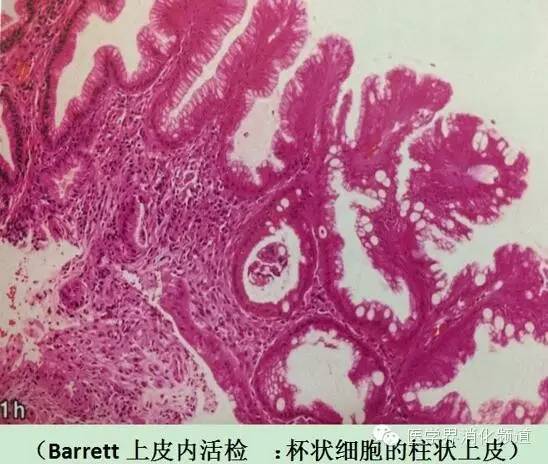 barrett食管的症状是什么,barrett食管症状可怕吗