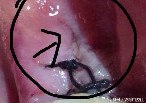 拔牙之后可以不拆线吗,拔牙后不拆线有影响吗