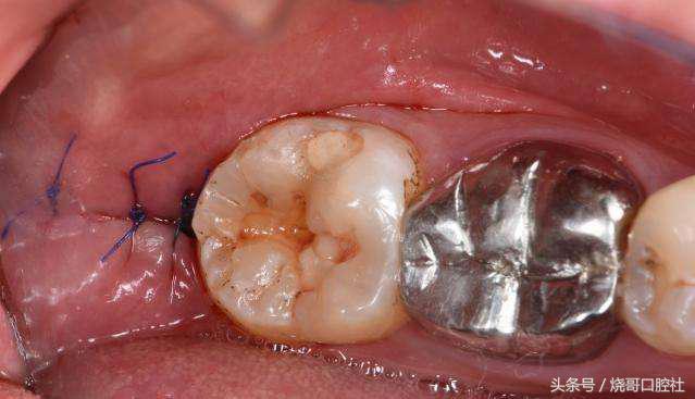 拔牙之后可以不拆线吗,拔牙后不拆线有影响吗