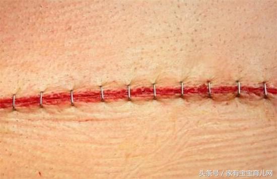 剖腹产横切好还是竖切好？原来有这么多缝合方式，你是属于哪种？