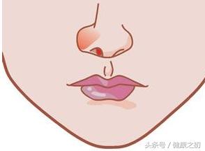 鼻息肉是怎样形成的有什么表现,鼻息肉是怎样形成的