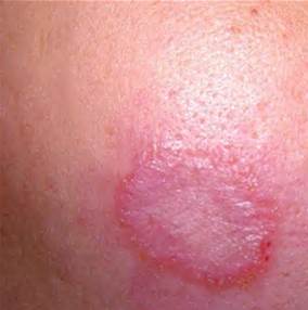 老婆被蚊子咬了一个大包,女生被蚊子咬了个包