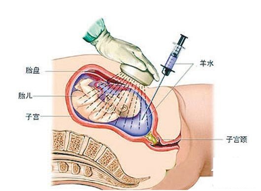 羊水穿刺要注意什么事项,做羊水穿刺的注意事项和准备