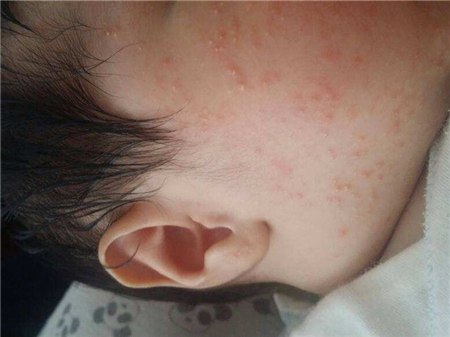 宝宝湿疹擦了很多药没好怎么办,宝宝湿疹护理实操