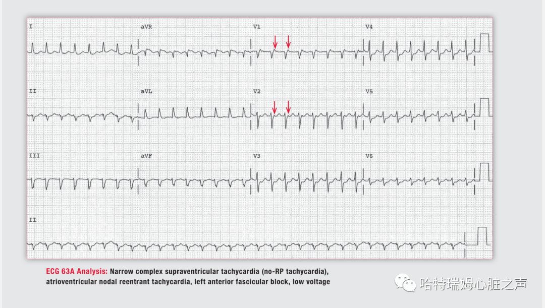「读心有术」329期：电轴极度左偏，病因有两种
