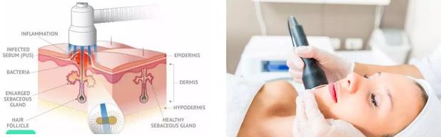 目前最有效果治疗痘印痘坑的方法,去痘印修复淡化痘印顺序