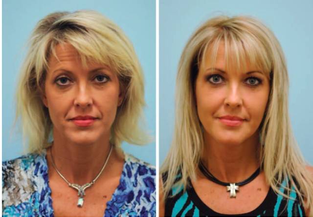 自体脂肪填充川字纹保持多久,自体脂肪填充10天内效果图