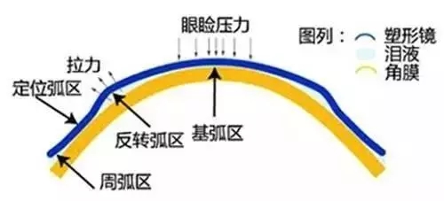 戴ok镜能恢复视力吗,ok镜可以永久矫正视力吗