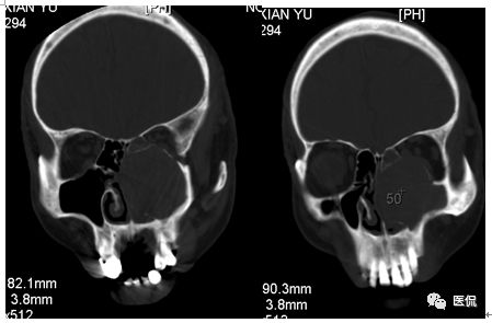 73岁患者无明显诱因出现左鼻塞、流脓涕，CT平扫发现密度影，怎么诊断？