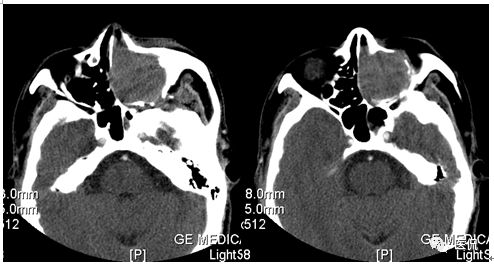 73岁患者无明显诱因出现左鼻塞、流脓涕，CT平扫发现密度影，怎么诊断？