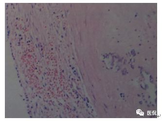 73岁患者无明显诱因出现左鼻塞、流脓涕，CT平扫发现密度影，怎么诊断？