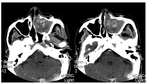 73岁患者无明显诱因出现左鼻塞、流脓涕，CT平扫发现密度影，怎么诊断？