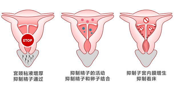 取环有什么讲求吗,取环容易出现什么意外