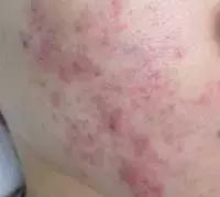 痘痘留下的黑红色痘印怎么去除,痘痘消下去有痘印怎么办