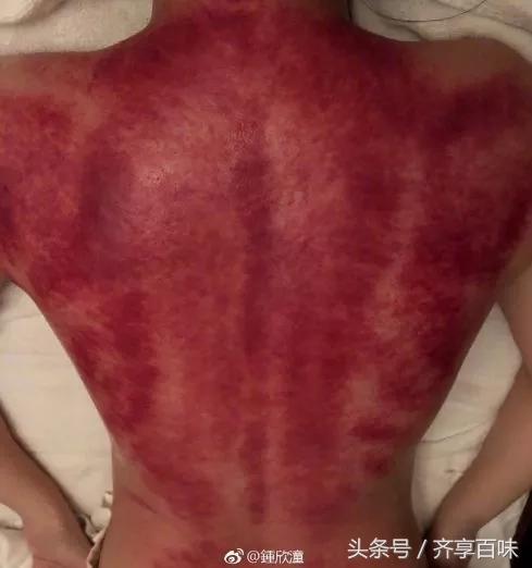 39岁阿娇晒照,阿娇刮痧后背效果