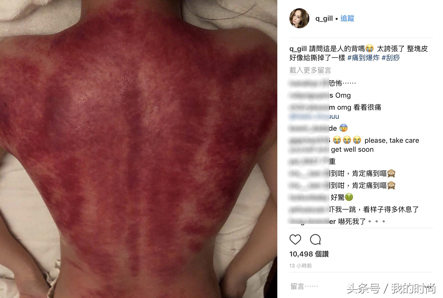 看见觉得疼！阿娇刮痧晒“血背照”：整块皮好像给撕掉了一样