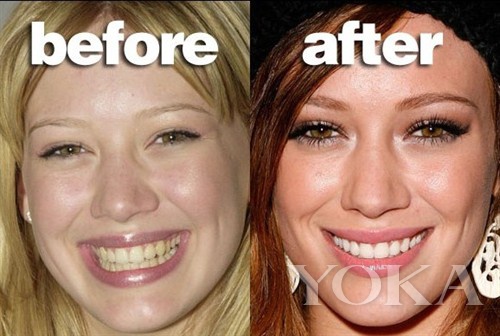 大变脸原来整牙才是高颜值,女星整牙都是越整越美